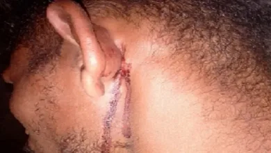 Hematomas causados, de acordo com denúncias, durante espancamento.- Foto: Reprodução/ Arquivo pessoal