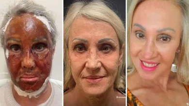 Antes e depois do peeling de fenol - Foto: Reprodução