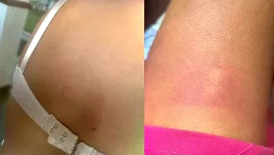 Mulher tinha escoriações nas costas e perna, além de corte no braço